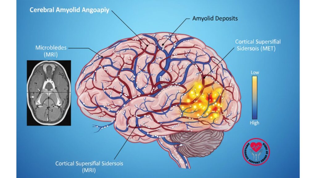 Evaluation of Cerebral Amyloid Angiopathy